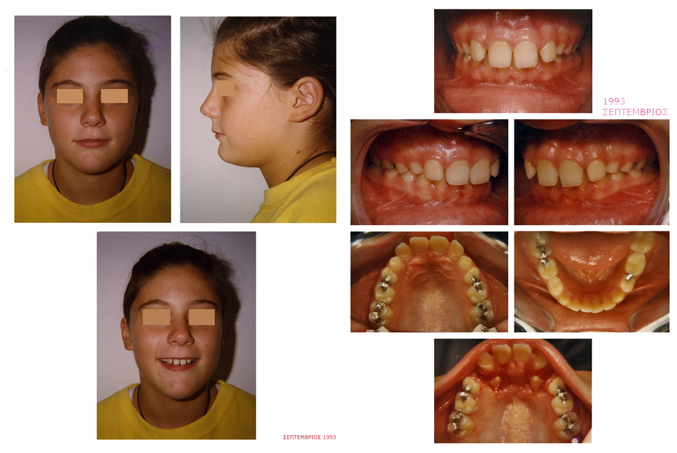 Έγκλειστοι κυνόδοντες - Ορθοδοντικός Δρ. Ζαρμπή