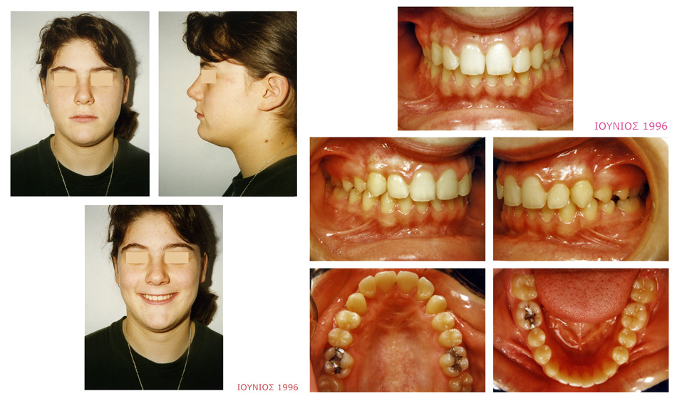 Έγκλειστοι κυνόδοντες - Ορθοδοντικός Δρ. Ζαρμπή