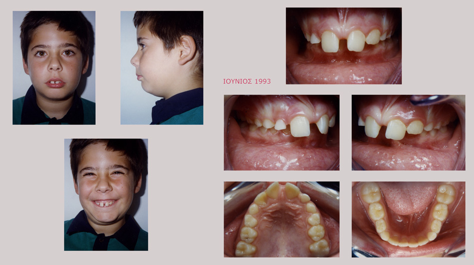 Στένωση, υπερκάλυψη κάτω δοντιών, έντονος οπισθογναθισμός, διάστημα προσθίων δοντιών