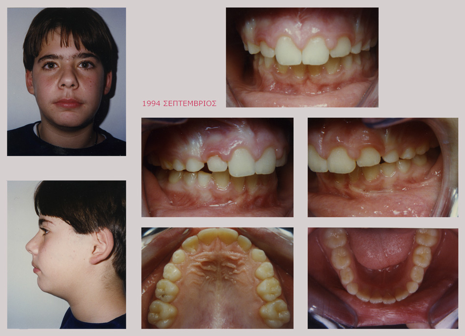 Στένωση, υπερκάλυψη κάτω δοντιών, έντονος οπισθογναθισμός, διάστημα προσθίων δοντιών