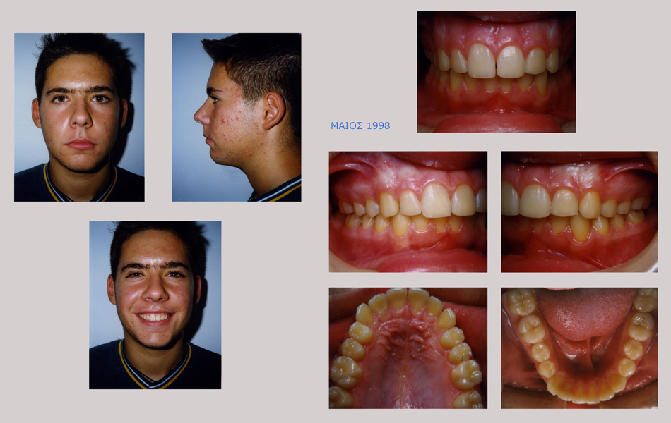 Στένωση, υπερκάλυψη κάτω δοντιών, έντονος οπισθογναθισμός, διάστημα προσθίων δοντιών