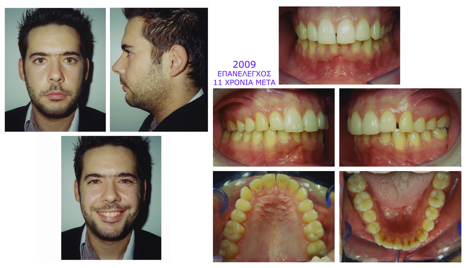 Στένωση, υπερκάλυψη κάτω δοντιών, έντονος οπισθογναθισμός, διάστημα προσθίων δοντιών