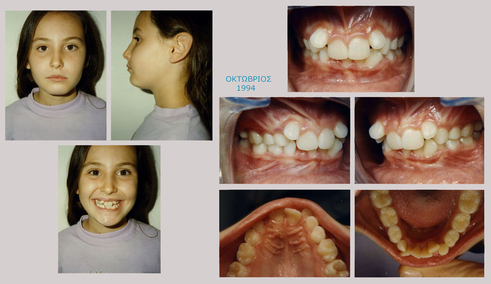 Συνωστισμός και υπερκάλυψη των κάτω δοντιών - Θεραπεία εξαγωγών