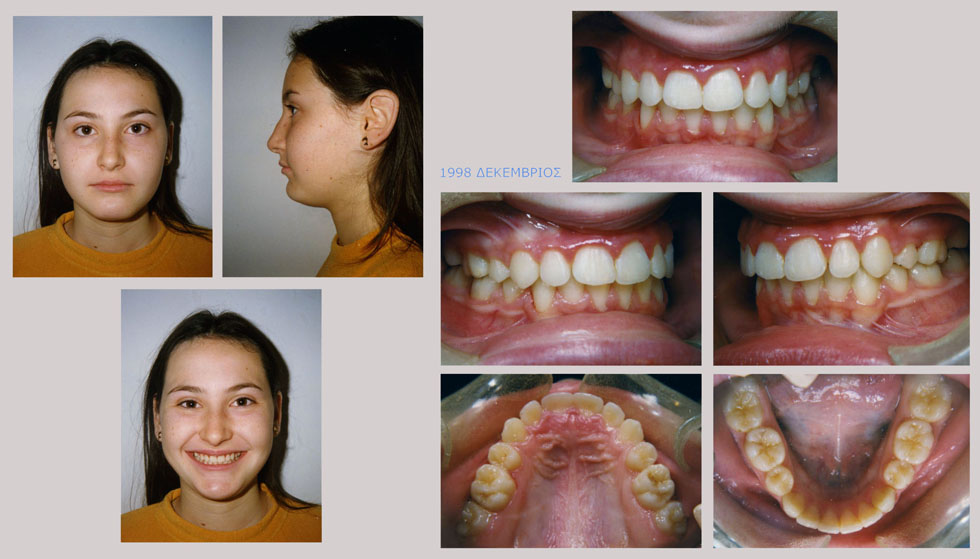 Συνωστισμός και υπερκάλυψη των κάτω δοντιών - Θεραπεία εξαγωγών