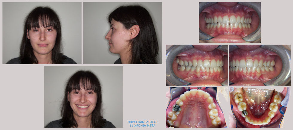 Συνωστισμός και υπερκάλυψη των κάτω δοντιών - Θεραπεία εξαγωγών
