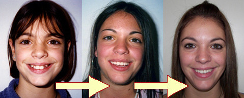 Ορθοδοντικές Θεραπείες Πρίν & Μετά - Ορθοδοντικός Δρ. Ζαρμπή