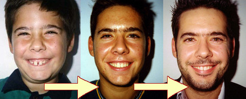 Ορθοδοντικές Θεραπείες Πρίν & Μετά - Ορθοδοντικός Δρ. Ζαρμπή