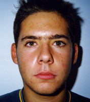 Ορθοδοντική δύο φάσεων - Ορθοδοντικός Δρ. Ζαρμπή