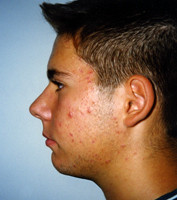 Ορθοδοντική δύο φάσεων - Ορθοδοντικός Δρ. Ζαρμπή