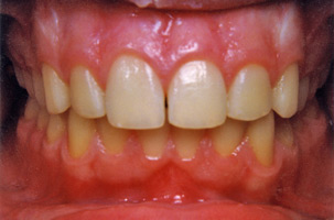 Ορθοδοντική δύο φάσεων - Ορθοδοντικός Δρ. Ζαρμπή