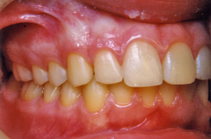 Ορθοδοντική δύο φάσεων - Ορθοδοντικός Δρ. Ζαρμπή