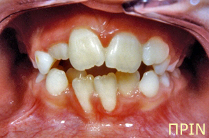 Ορθοδοντική θεραπεία για εφήβους - Ορθοδοντικός Δρ. Ζαρμπή