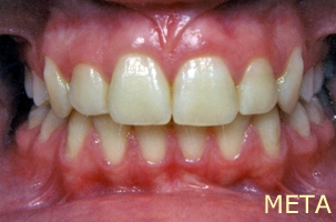 Ορθοδοντική θεραπεία για εφήβους - Ορθοδοντικός Δρ. Ζαρμπή