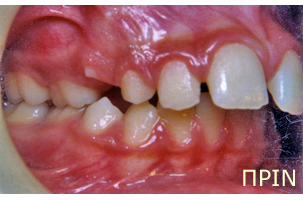 Ορθοδοντική θεραπεία για εφήβους - Ορθοδοντικός Δρ. Ζαρμπή