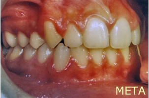 Ορθοδοντική θεραπεία για εφήβους - Ορθοδοντικός Δρ. Ζαρμπή