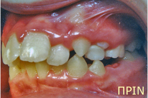 Ορθοδοντική θεραπεία για εφήβους - Ορθοδοντικός Δρ. Ζαρμπή