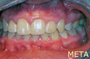 Ορθοδοντική θεραπεία για εφήβους - Ορθοδοντικός Δρ. Ζαρμπή