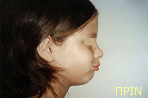 Ορθοδοντική θεραπεία για εφήβους - Ορθοδοντικός Δρ. Ζαρμπή