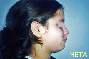 Ορθοδοντική θεραπεία για εφήβους - Ορθοδοντικός Δρ. Ζαρμπή