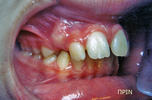 Ορθοδοντική θεραπεία για εφήβους - Ορθοδοντικός Δρ. Ζαρμπή