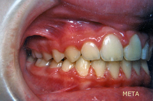 Ορθοδοντική θεραπεία για εφήβους - Ορθοδοντικός Δρ. Ζαρμπή