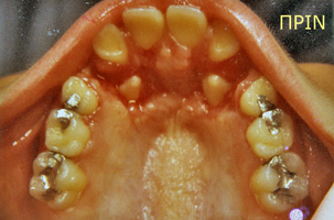 Ορθοδοντική θεραπεία για εφήβους - Ορθοδοντικός Δρ. Ζαρμπή