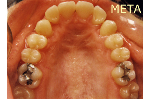 Ορθοδοντική θεραπεία για εφήβους - Ορθοδοντικός Δρ. Ζαρμπή