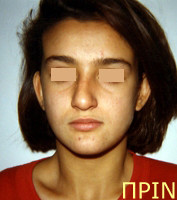 Ορθοδοντική θεραπεία για εφήβους - Ορθοδοντικός Δρ. Ζαρμπή