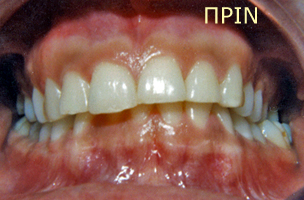 Ορθοδοντική θεραπεία για εφήβους - Ορθοδοντικός Δρ. Ζαρμπή