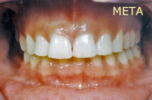 Ορθοδοντική θεραπεία για εφήβους - Ορθοδοντικός Δρ. Ζαρμπή