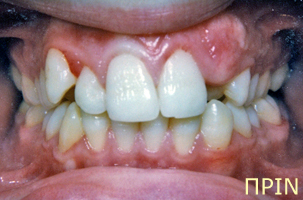 Ορθοδοντική θεραπεία για εφήβους - Ορθοδοντικός Δρ. Ζαρμπή