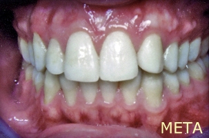 Ορθοδοντική θεραπεία για εφήβους - Ορθοδοντικός Δρ. Ζαρμπή