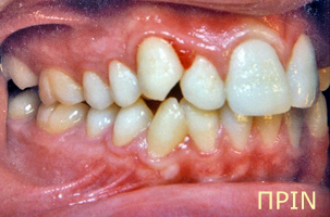 Ορθοδοντική θεραπεία για εφήβους - Ορθοδοντικός Δρ. Ζαρμπή