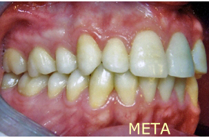 Ορθοδοντική θεραπεία για εφήβους - Ορθοδοντικός Δρ. Ζαρμπή