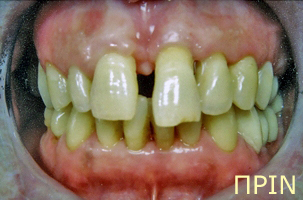 Ορθοδοντική θεραπεία για εφήβους - Ορθοδοντικός Δρ. Ζαρμπή