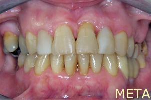 Ορθοδοντική θεραπεία για εφήβους - Ορθοδοντικός Δρ. Ζαρμπή