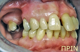 Ορθοδοντική θεραπεία για εφήβους - Ορθοδοντικός Δρ. Ζαρμπή