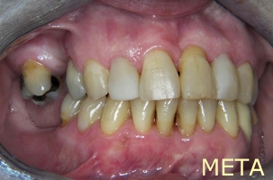 Ορθοδοντική θεραπεία για εφήβους - Ορθοδοντικός Δρ. Ζαρμπή