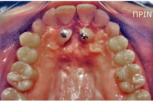 Ορθοδοντική θεραπεία - Ορθοδοντικός Δρ. Ζαρμπή
