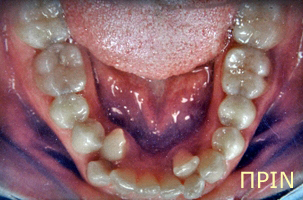Ορθοδοντική θεραπεία - Ορθοδοντικός Δρ. Ζαρμπή