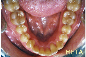 Ορθοδοντική θεραπεία - Ορθοδοντικός Δρ. Ζαρμπή