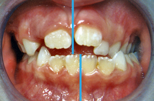 Προληπτική ορθοδοντική - Δρ. Ζαρμπή