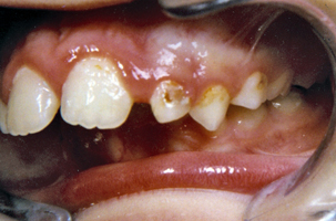 Προληπτική ορθοδοντική - Δρ. Ζαρμπή