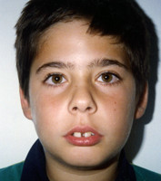 Ορθοδοντική δύο φάσεων - Ορθοδοντικός Δρ. Ζαρμπή