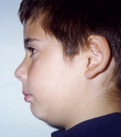 Ορθοδοντική δύο φάσεων - Ορθοδοντικός Δρ. Ζαρμπή