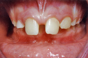 Ορθοδοντική δύο φάσεων - Ορθοδοντικός Δρ. Ζαρμπή