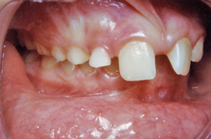 Ορθοδοντική δύο φάσεων - Ορθοδοντικός Δρ. Ζαρμπή