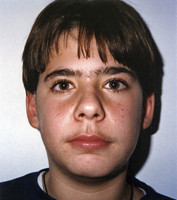 Ορθοδοντική δύο φάσεων - Ορθοδοντικός Δρ. Ζαρμπή