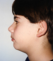 Ορθοδοντική δύο φάσεων - Ορθοδοντικός Δρ. Ζαρμπή