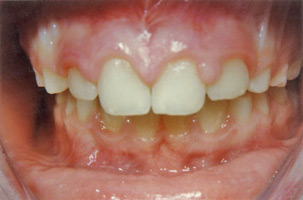 Ορθοδοντική δύο φάσεων - Ορθοδοντικός Δρ. Ζαρμπή